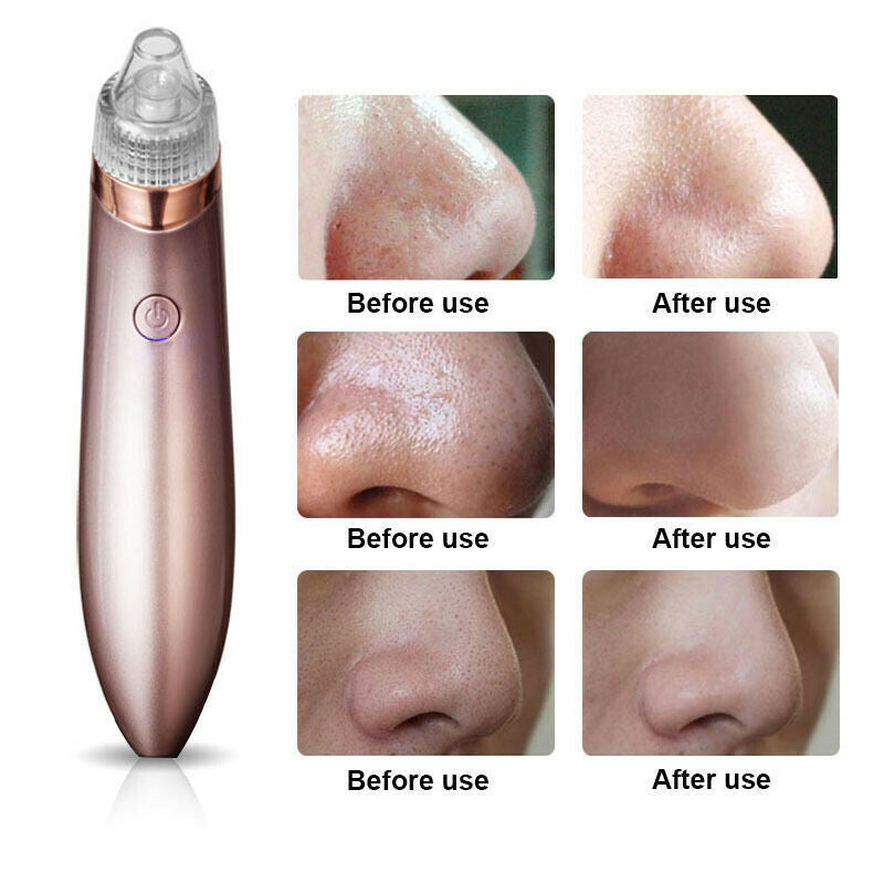 Electric Blackhead Vacuum Pore Cleaner Acne Pimple Remover Strong Suction Tool